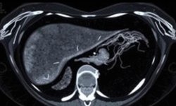 Эластометрия печени (Фиброскан): полное руководство для пациента